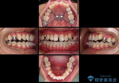 急速拡大装置 歯列弓を拡大して非抜歯ワイヤー矯正の治療中