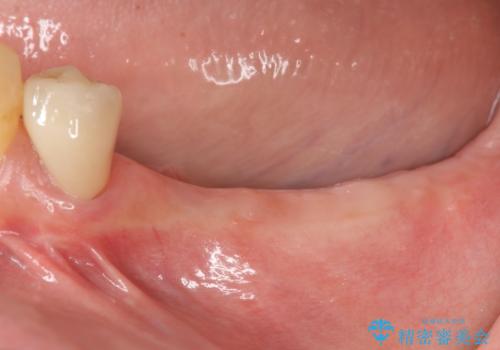 入れ歯を無くした インプラント治療の希望の症例 治療前