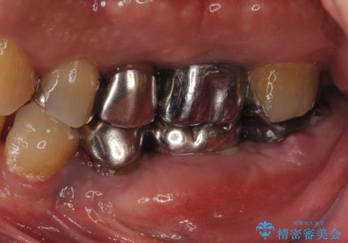 歯が割れているといわれた 奥歯にインプラントをしていきたい 全体的な治療