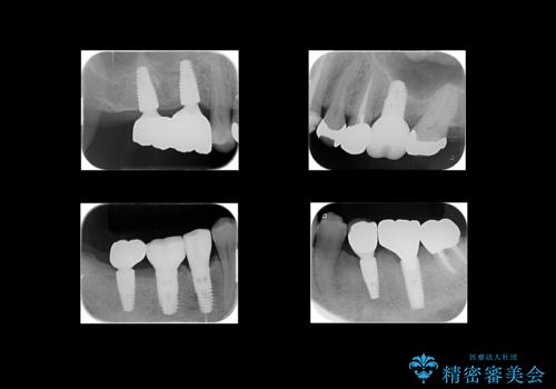 歯が割れているといわれた　奥歯にインプラントをしていきたいの治療後