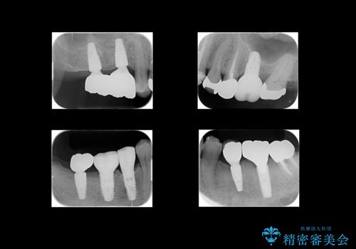 歯が割れているといわれた 奥歯にインプラントをしていきたい 全体的な治療の治療後
