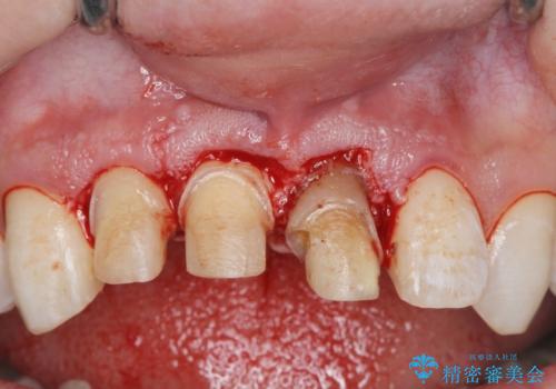 前歯の変色 審美性の改善の治療中
