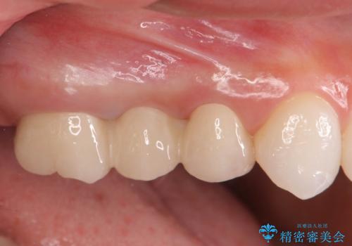 割れてしまった奥歯 セラミックブリッジ治療の治療後