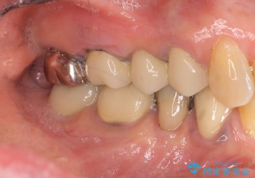 過大な咬合力で破折した奥歯 インプラント治療で咬合機能の回復の治療前