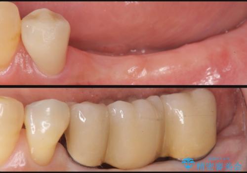 入れ歯を無くした　インプラント治療の希望