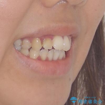 開咬と前突を改善 ワイヤー装置での抜歯矯正の治療前(顔貌)