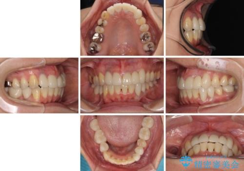 非対称の前歯を整えたい　矯正治療と審美治療の総合歯科診療の治療後