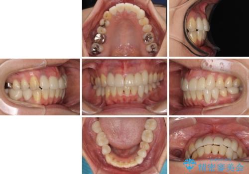 非対称の前歯を整えたい 矯正治療と審美治療の総合歯科診療の治療後