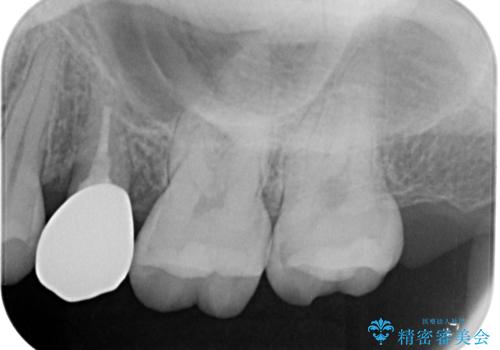 虫歯になった気がするので治療したい ゴールドインレー修復の治療前