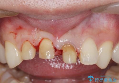 前歯の変色 審美性の改善の治療中