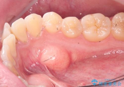 矯正の後戻りを防ぐ骨隆起の切除