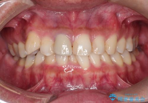 【インビザライン】八重歯と歯のでこぼこが気になる!の症例 治療前