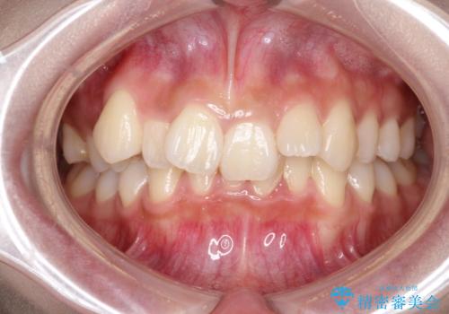 【ワイヤー矯正】前歯のガタガタを治したい。の治療前