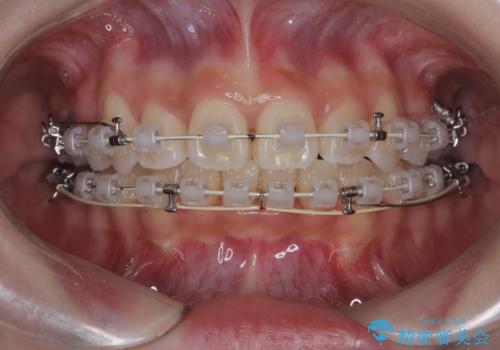 【ワイヤー矯正】前歯のガタガタを治したい。の治療中