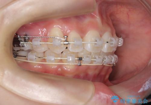 【ワイヤー矯正】前歯のガタガタを治したい。の治療中