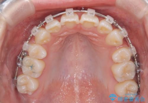 【ワイヤー矯正】前歯のガタガタを治したい。の治療中
