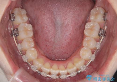 【ワイヤー矯正】前歯のガタガタを治したい。の治療中