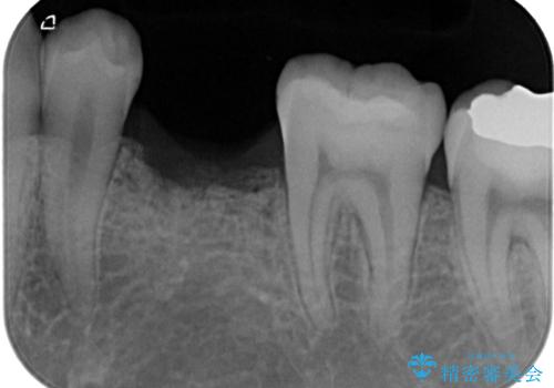 永久歯の先天欠如　インプラントによる補綴の治療前