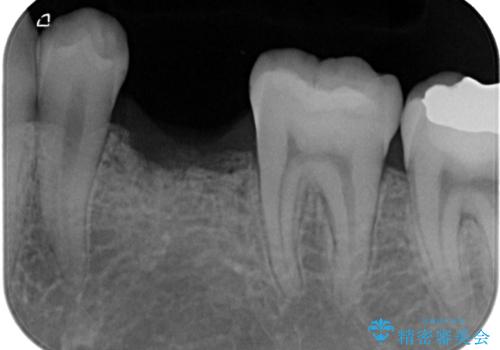 永久歯の先天欠如 インプラントによる補綴の治療前