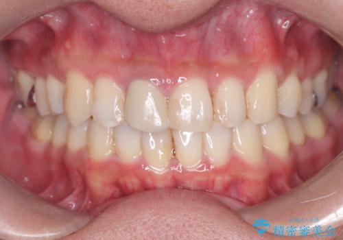 【インビザライン】八重歯と歯のでこぼこが気になる!の症例 治療後