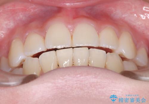 【ワイヤー矯正】前歯のガタガタを治したい。の治療後
