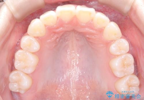 【ワイヤー矯正】前歯のガタガタを治したい。の治療後