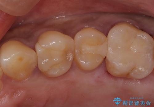 【セラミックインレー】虫歯になった詰め物部分を修復の治療前