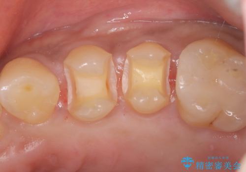 【セラミックインレー】虫歯になった詰め物部分を修復の治療中