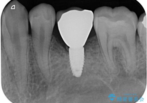 永久歯の先天欠如　インプラントによる補綴の治療後