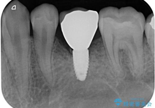 永久歯の先天欠如 インプラントによる補綴の治療後
