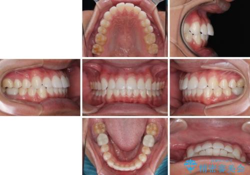 楽してデコボコを治したい ワイヤー矯正治療の治療後