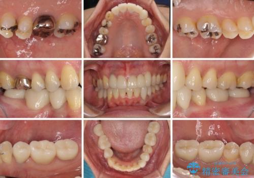 非対称の前歯を整えたい　矯正治療と審美治療の総合歯科診療の治療後