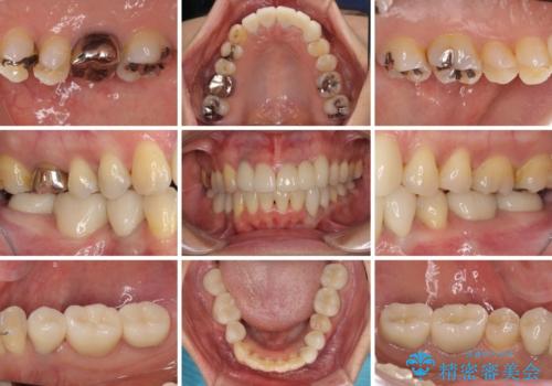 非対称の前歯を整えたい 矯正治療と審美治療の総合歯科診療の治療後
