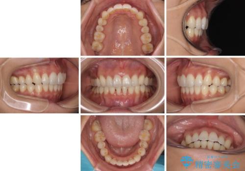 上顎前突をしっかりと治す 補助装置を使用したワイヤー矯正の治療後
