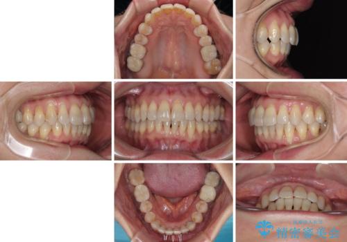 マウスピース矯正とセラミック治療で綺麗な口元にの治療後