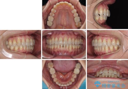 マウスピース矯正とセラミック治療で綺麗な口元にの治療後