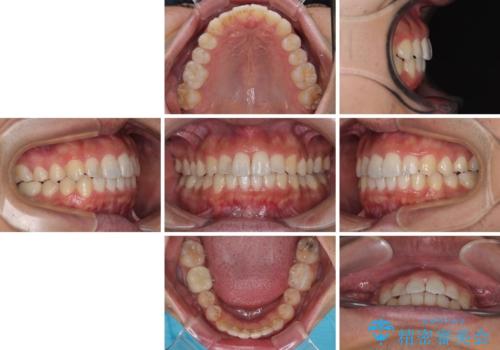 前歯のデコボコと突出感をマウスピース矯正できれいにの治療後