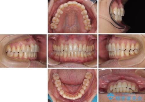 前歯のデコボコを治したい インビザラインによる矯正治療の治療後