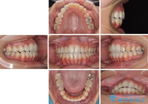 開咬と前突を改善 ワイヤー装置での抜歯矯正の治療後