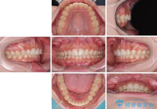 ディープバイトを短期間で改善　ワイヤー矯正治療の治療後