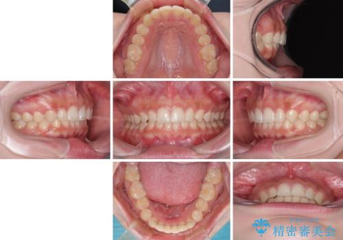 ディープバイトを短期間で改善 ワイヤー矯正治療の治療後