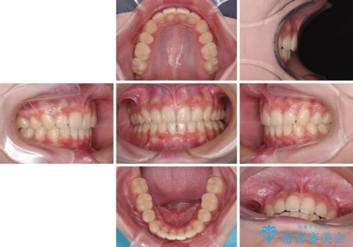 飛び出した前歯と八重歯を改善　ワイヤー装置での抜歯矯正の治療後