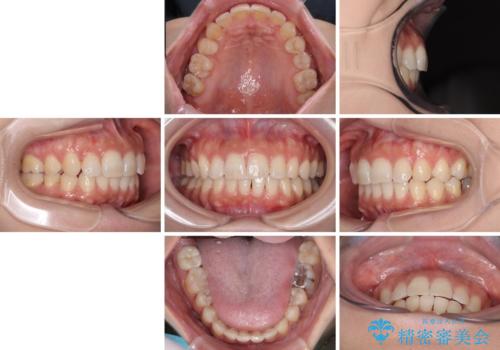 目立つ八重歯を改善　ワイヤー装置での抜歯矯正の治療後