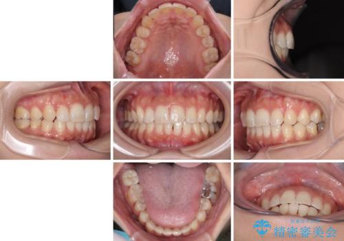 目立つ八重歯を改善 ワイヤー装置での抜歯矯正の治療後