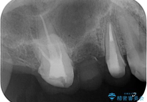 割れてしまった奥歯 セラミックブリッジ治療の治療中
