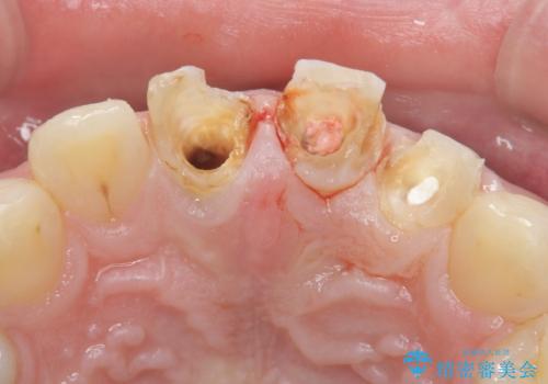前歯の変色 審美性の改善の治療前