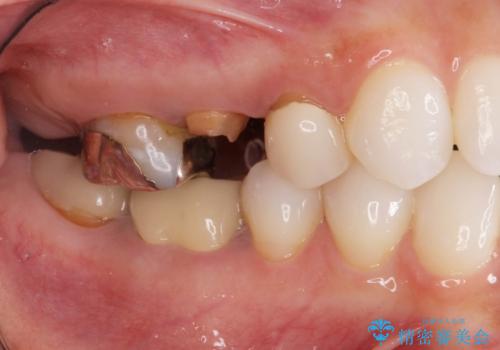 割れてしまった奥歯 セラミックブリッジ治療の症例 治療前
