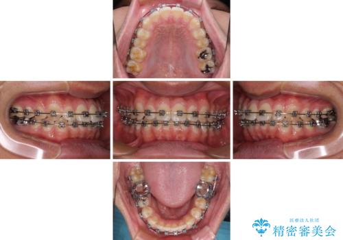 楽してデコボコを治したい ワイヤー矯正治療の治療中