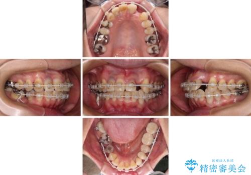 非対称の前歯を整えたい　矯正治療と審美治療の総合歯科診療の治療中