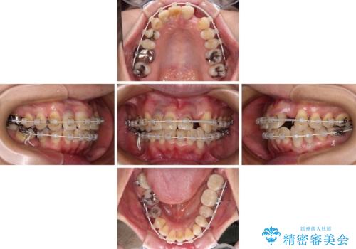 非対称の前歯を整えたい 矯正治療と審美治療の総合歯科診療の治療中